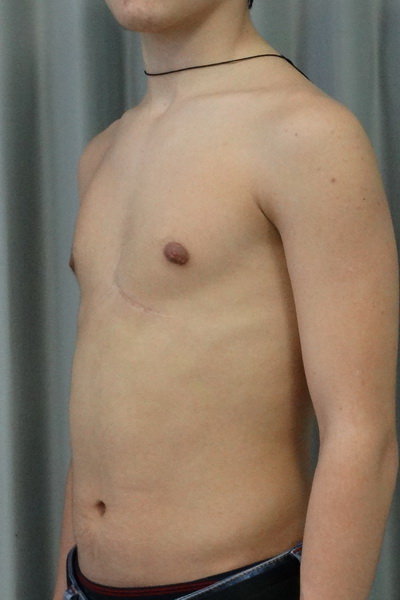 Килевидная деформация грудной клетки - показания к хирургической коррекции