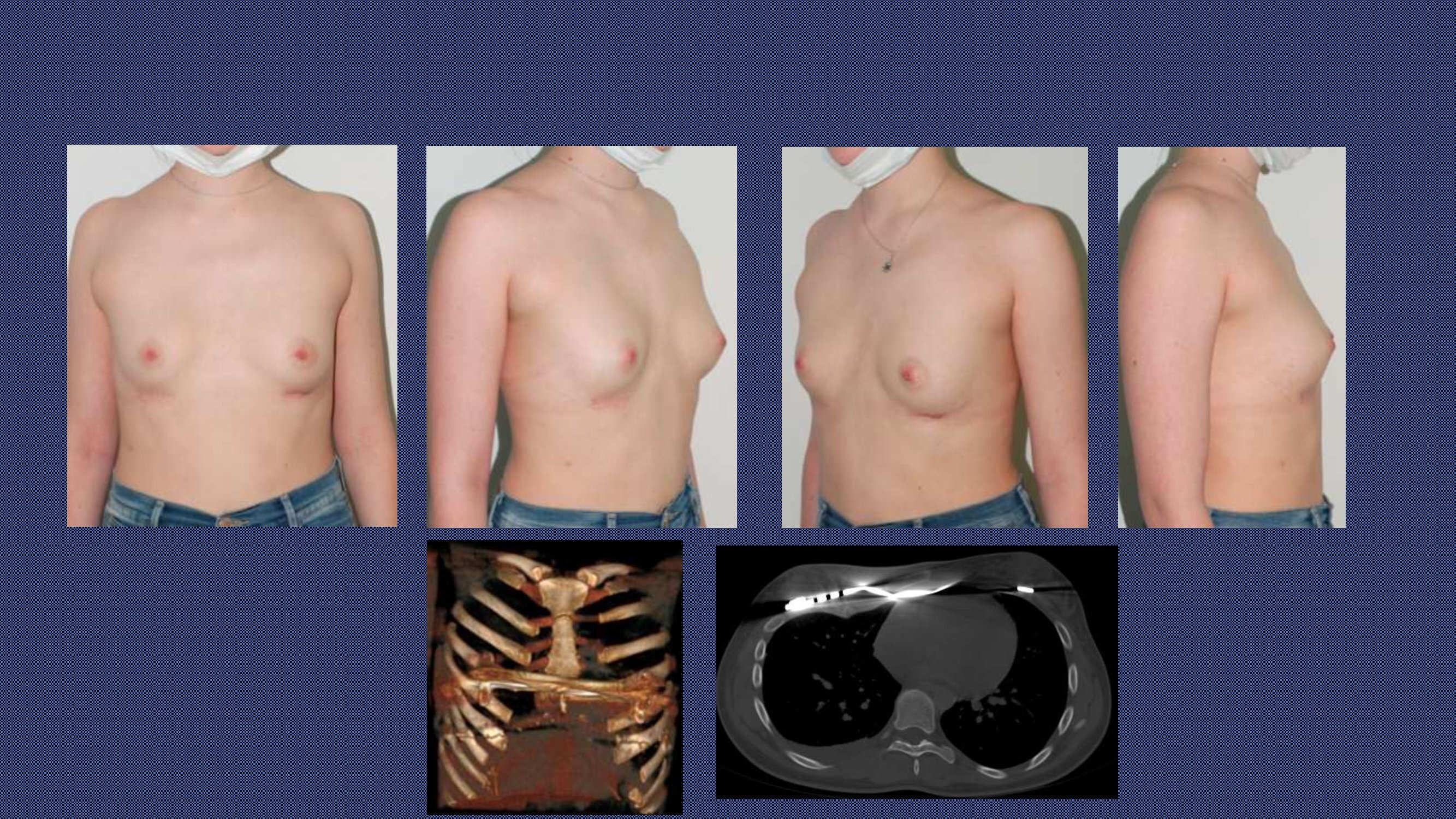 тубулярная деформация груди у женщин фото 96