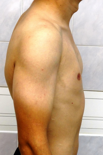 Фото операции при синдроме поланда thumbnail